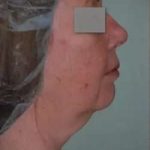 Face Neck Lift Before & After Patient #167
