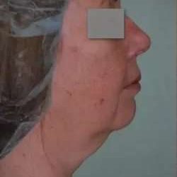 Face Neck Lift Before & After Patient #167