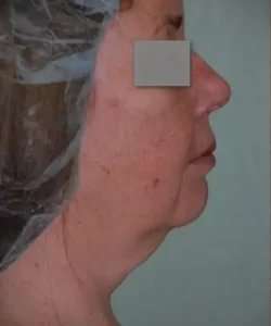 Face Neck Lift Before & After Patient #167