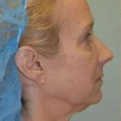 Face Neck Lift Before & After Patient #170