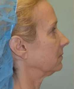 Face Neck Lift Before & After Patient #170