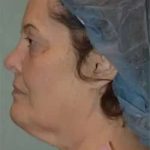 Face Neck Lift Before & After Patient #173