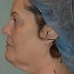 Face Neck Lift Before & After Patient #173