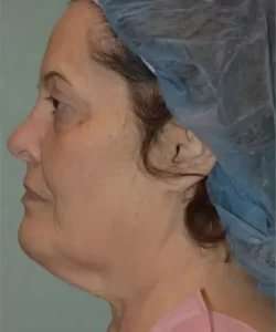 Face Neck Lift Before & After Patient #173