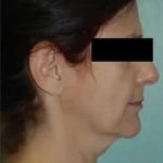 Face Neck Lift Before & After Patient #176