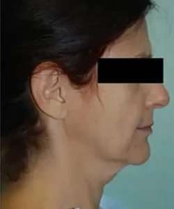 Face Neck Lift Before & After Patient #176