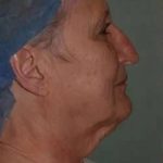 Face Neck Lift Before & After Patient #179