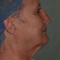 Face Neck Lift Before & After Patient #179