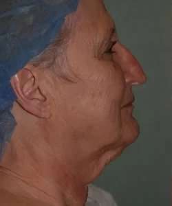 Face Neck Lift Before & After Patient #179