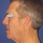 Face Neck Lift Before & After Patient #182