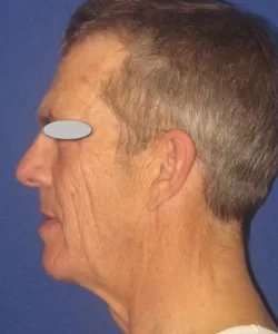 Face Neck Lift Before & After Patient #182