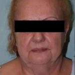 Face Neck Lift Before & After Patient #185