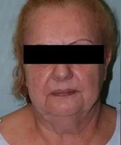 Face Neck Lift Before & After Patient #185