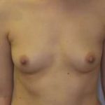 Breast Augmentation Before & After Patient #191
