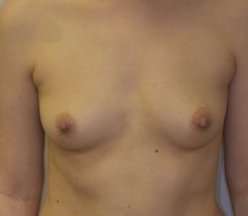 Breast Augmentation Before & After Patient #191