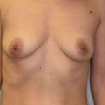 Breast Augmentation Before & After Patient #194