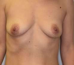 Breast Augmentation Before & After Patient #194