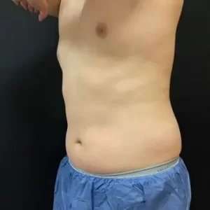 Coolsculpting Before & After Patient #251