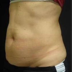 Coolsculpting Before & After Patient #254