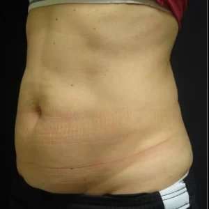 Coolsculpting Before & After Patient #254