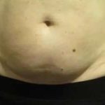 Coolsculpting Before & After Patient #259