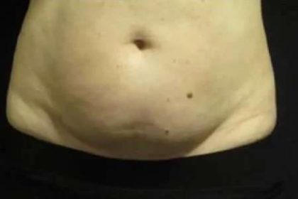 Coolsculpting Before & After Patient #259