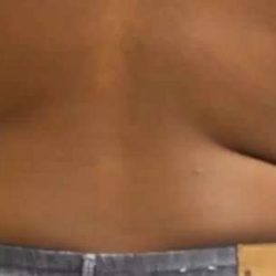 Coolsculpting Before & After Patient #262