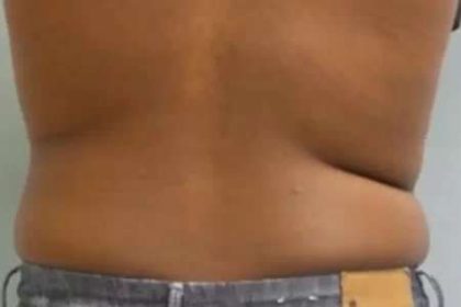 Coolsculpting Before & After Patient #262