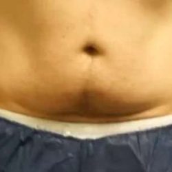 Coolsculpting Before & After Patient #265