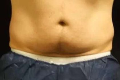 Coolsculpting Before & After Patient #265
