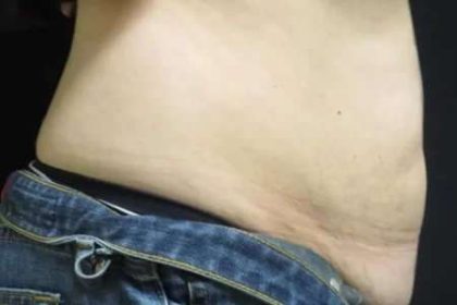 Coolsculpting Before & After Patient #268