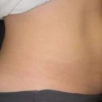 Coolsculpting Before & After Patient #271