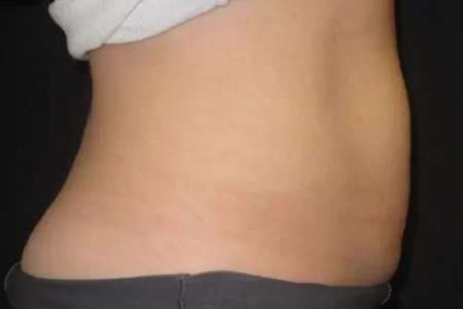 Coolsculpting Before & After Patient #271