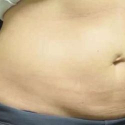 Coolsculpting Before & After Patient #274