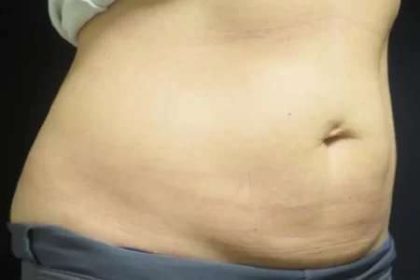 Coolsculpting Before & After Patient #274