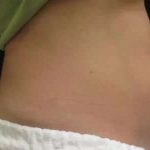 Coolsculpting Before & After Patient #277