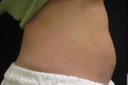 Coolsculpting Before & After Patient #277