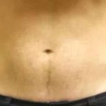 Coolsculpting Before & After Patient #280