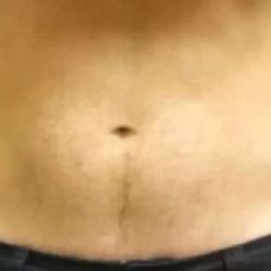 Coolsculpting Before & After Patient #280