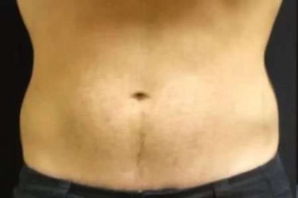 Coolsculpting Before & After Patient #280