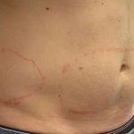 Coolsculpting Before & After Patient #283