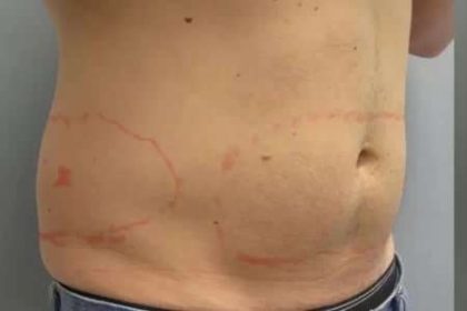 Coolsculpting Before & After Patient #283