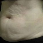 Coolsculpting Before & After Patient #288