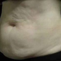 Coolsculpting Before & After Patient #288