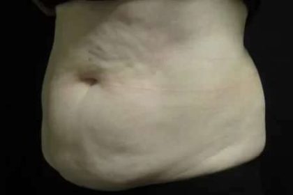 Coolsculpting Before & After Patient #288