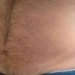 Coolsculpting Before & After Patient #291