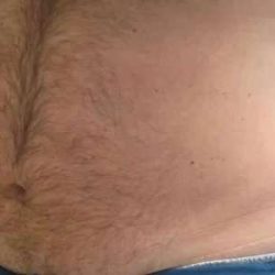Coolsculpting Before & After Patient #291