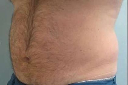 Coolsculpting Before & After Patient #291