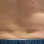 Coolsculpting Before & After Patient #296
