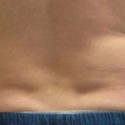 Coolsculpting Before & After Patient #296